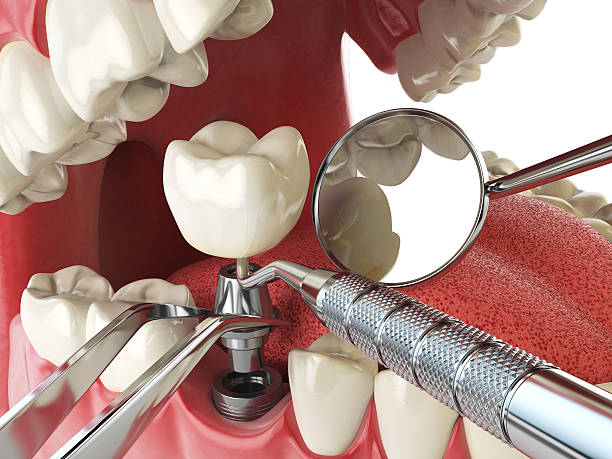 Best Emergency Tooth Extraction in Bolindale, OH
